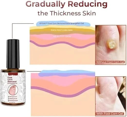 Feet Corn Removal Serum 30ml