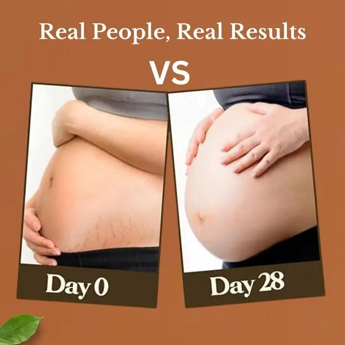 Stretch Marks Removal Cream – 50g