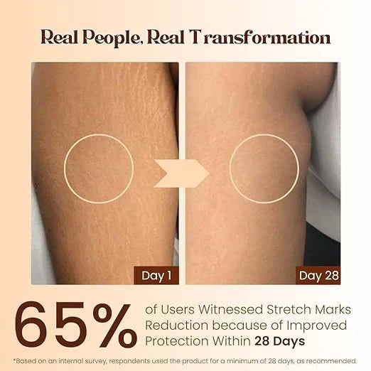 Stretch Marks Removal Cream – 50g