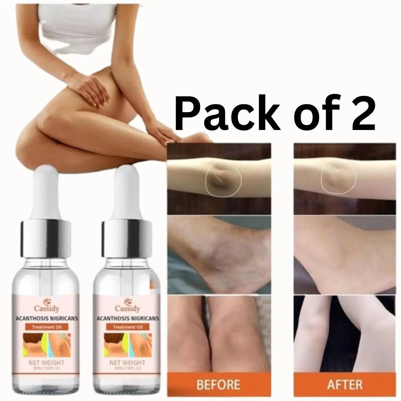 CASSIDY Acanthosis Nigricans Oil