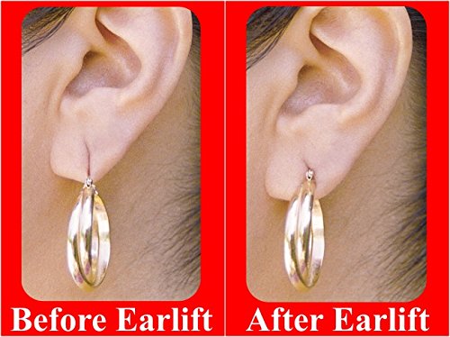 Pain-Free Earring Support Patches (100 Pieces)