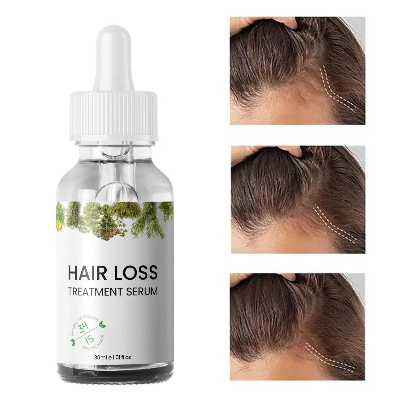Hair Loss Treatment Serum – 30ml
