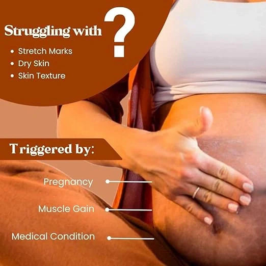 Stretch Marks Removal Cream – 50g