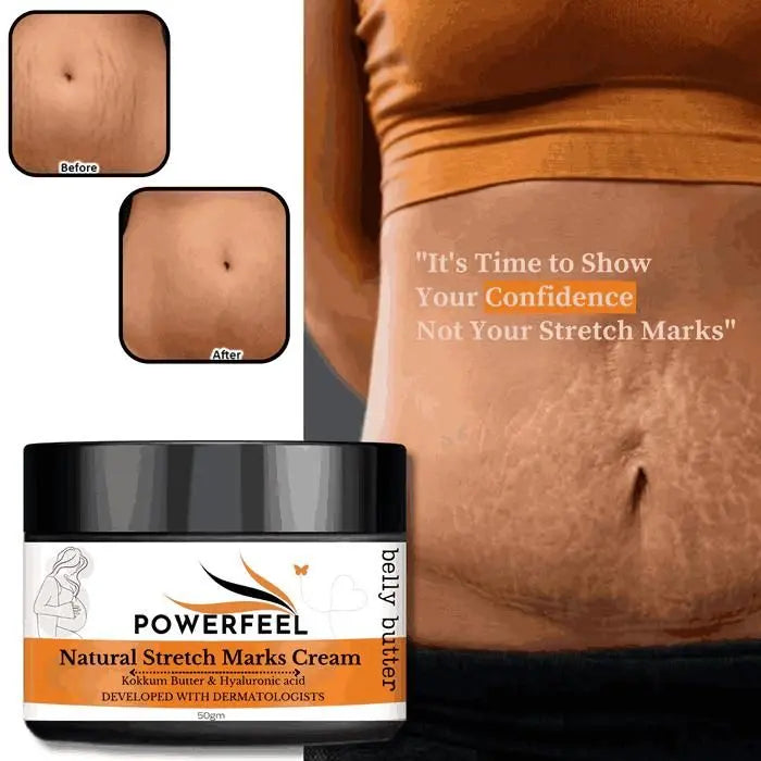 Stretch Marks Removal Cream – 50g