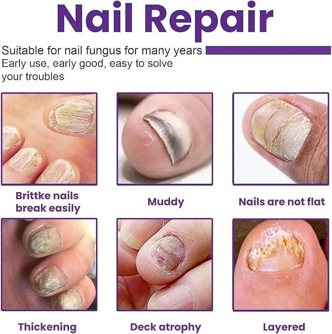 Fungi Free Nail Treatment Serum – 15ml (Pack of 2)