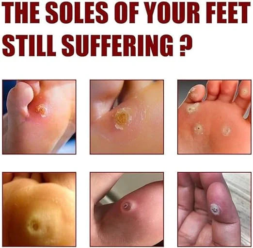 Feet Corn Removal Serum 30ml
