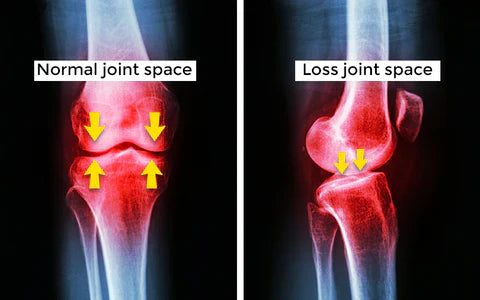 Instant Joint Pain Relief
